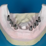 Protesi fissa Osteointegrata