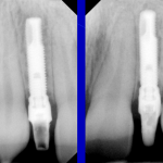 Ortodonzia&ImpiantiOsteointegrati3