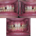 Ortodonzia&ImpiantiOsteointegrati4