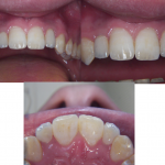 Ortodonzia&ImpiantiOsteointegrati5