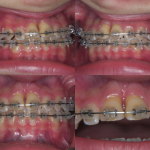 Traumatologia dentaria2