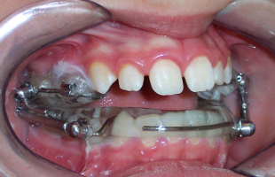 Trattamento ortodontico con apparecchio di Herbst