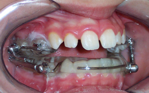 Orthodontic treatment by Herbst appliance