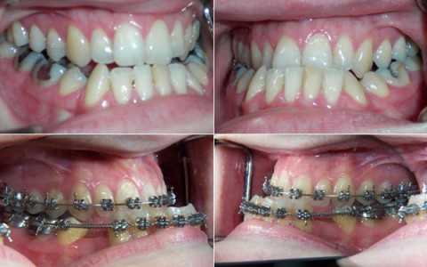 Aesthetics and oral functions in Orthodontics