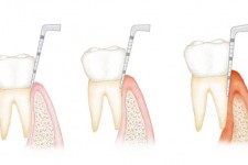 Periodontology