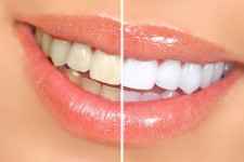 Whitening