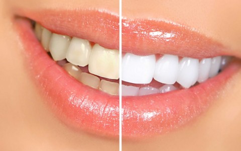 Whitening