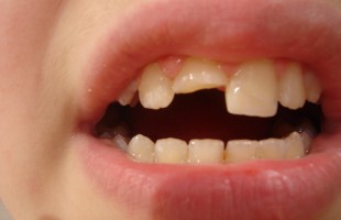 Orthodontic multidisciplinary approach in Dental Trauma, Impacted Teeth, Dental agenesis, Prosthetic and Implant needs