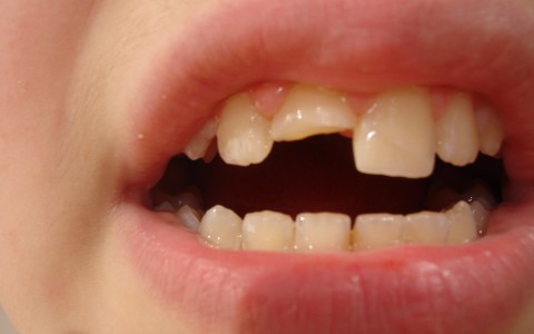 Approccio Ortodontico e multidisciplinare in casi di: traumatologia dentaria, inclusioni e agenesie dentarie, problematiche protesiche ed esigenze implantari.