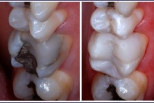 Restorative dentistry