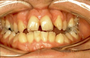 Biomeccanica Ortodontica secondo la filosofia MBT