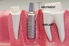 Implantology