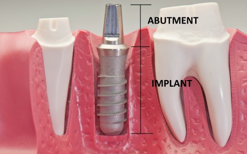 Implantology