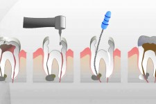 Endodonzia