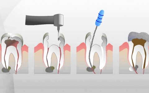 Endodonzia