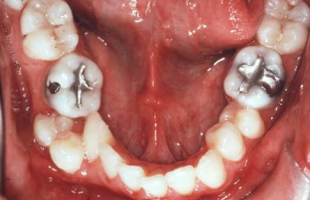 Failure, relapse and retention in Orthodontics