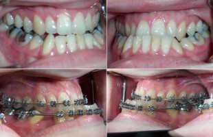 Orthodontics and Orthognatic Surgery : multidisciplinary approach and treatment planning in complex cases